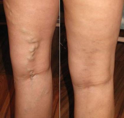 leczenie chorób żylnych